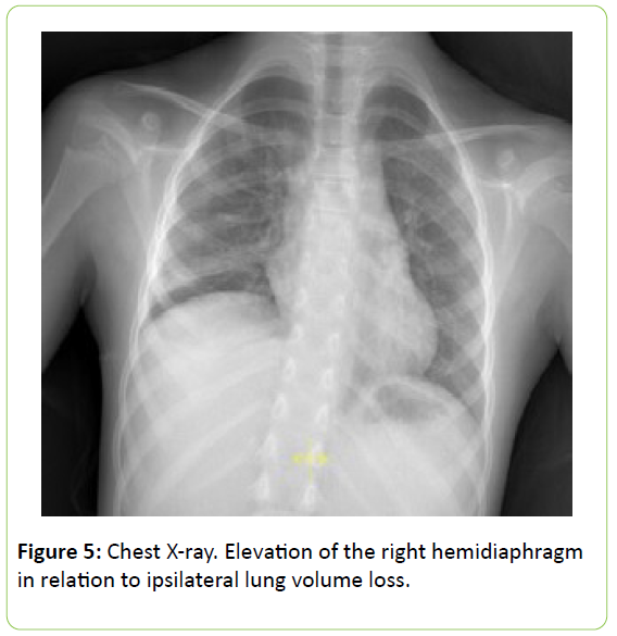 chronic-obstructive-pulmonary-disease-Chest-X-ray-Elevation