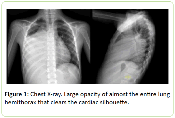 chronic-obstructive-pulmonary-disease-Chest-X-ray-Large