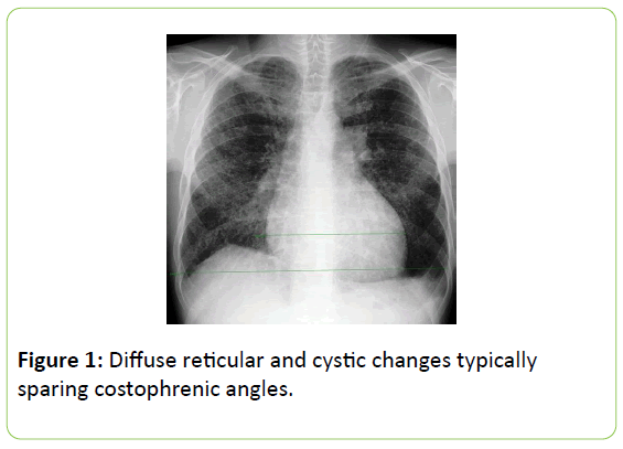 chronic-obstructive-pulmonary-disease-Diffuse-reticular-cystic