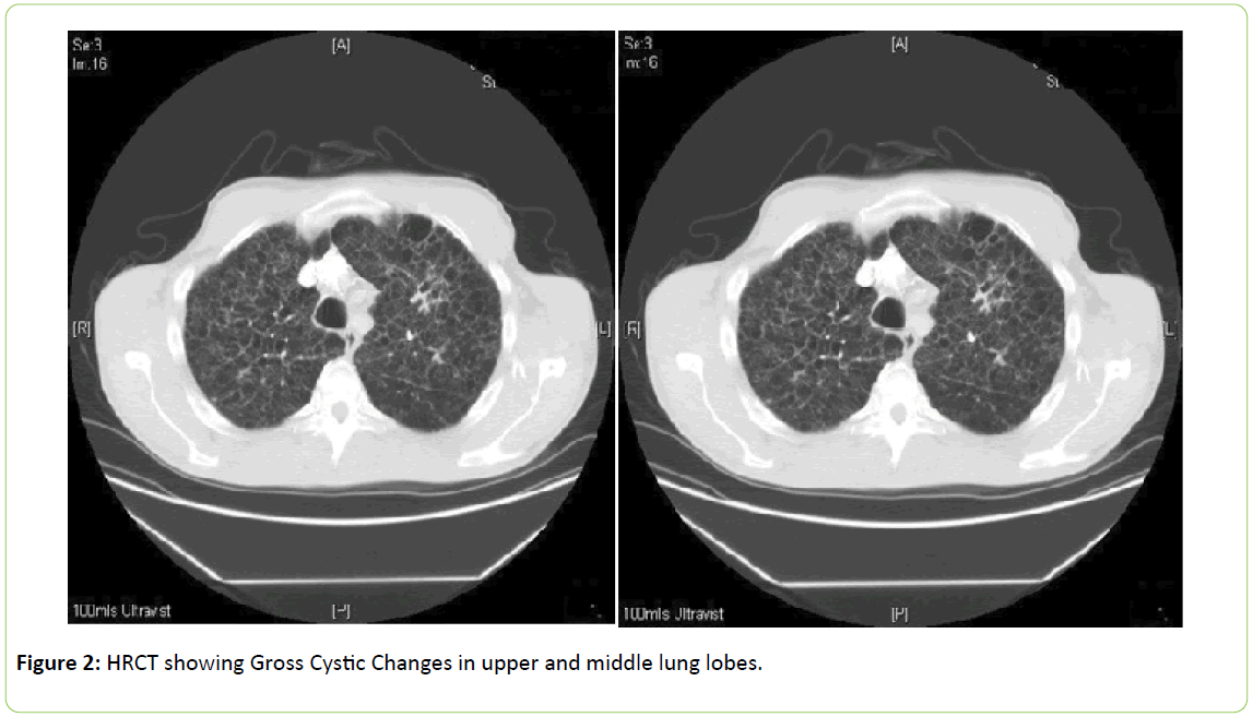 chronic-obstructive-pulmonary-disease-Gross-Cystic-Changes