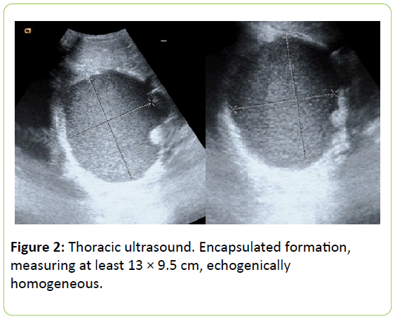 chronic-obstructive-pulmonary-disease-Thoracic-ultrasound