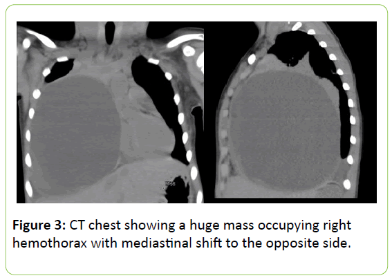 chronic-obstructive-pulmonary-disease-huge-mass-occupying